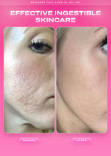 Side-by-side facial skin photographs labeled before and after in an It Girl Skin graphic.