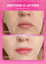 Close-up photographs of a woman's lower face labeled before and after.